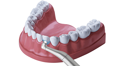 Zahnbehandlung professionelle Zahnreinigung